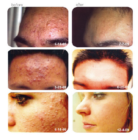 acne_picture-_your_skin1_i7m7_6uc0_w57z[1]